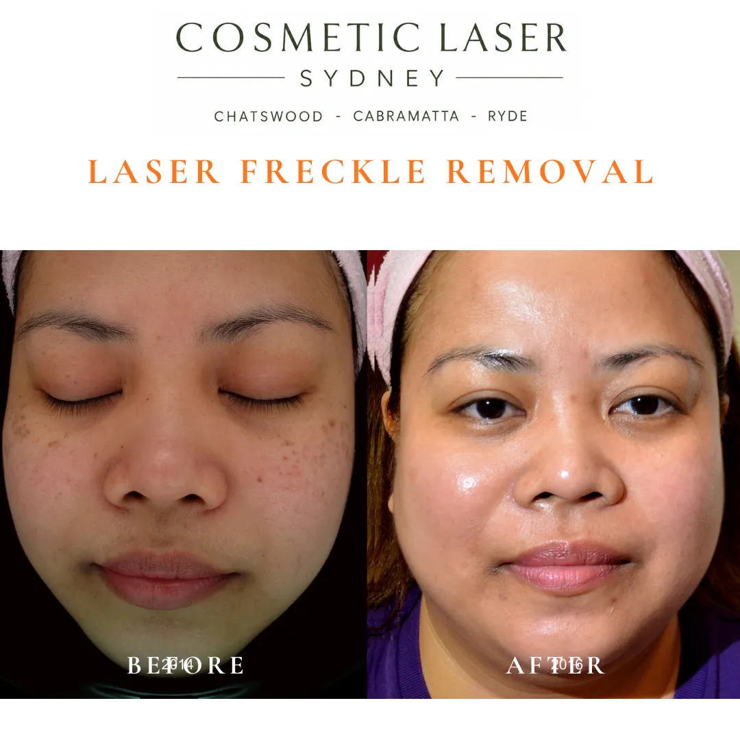 Before and after laser treatment of ABNOM pigmentation on the cheeks