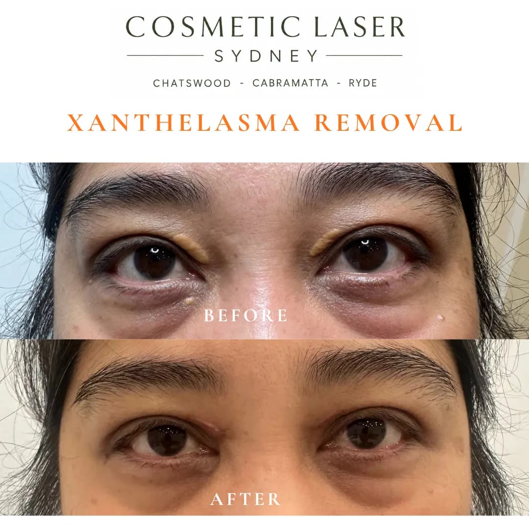 Before and 1-month after CO₂ laser treatment for upper eyelid xanthelasma plaques showing smooth cosmetic healing by Dr Peter Kim. Before and 1-month after CO₂ laser treatment for upper eyelid xanthelasma plaques showing smooth cosmetic healing by Dr Peter Kim.