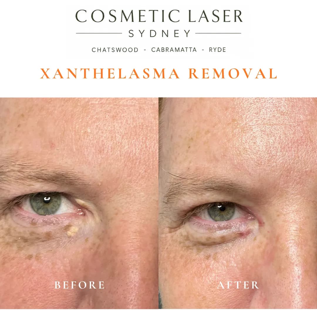 4-week post-treatment photo of CO₂ laser xanthelasma removal from upper and lower eyelids, performed by Dr Peter Kim. 4-week post-treatment photo of CO₂ laser xanthelasma removal from upper and lower eyelids, performed by Dr Peter Kim.