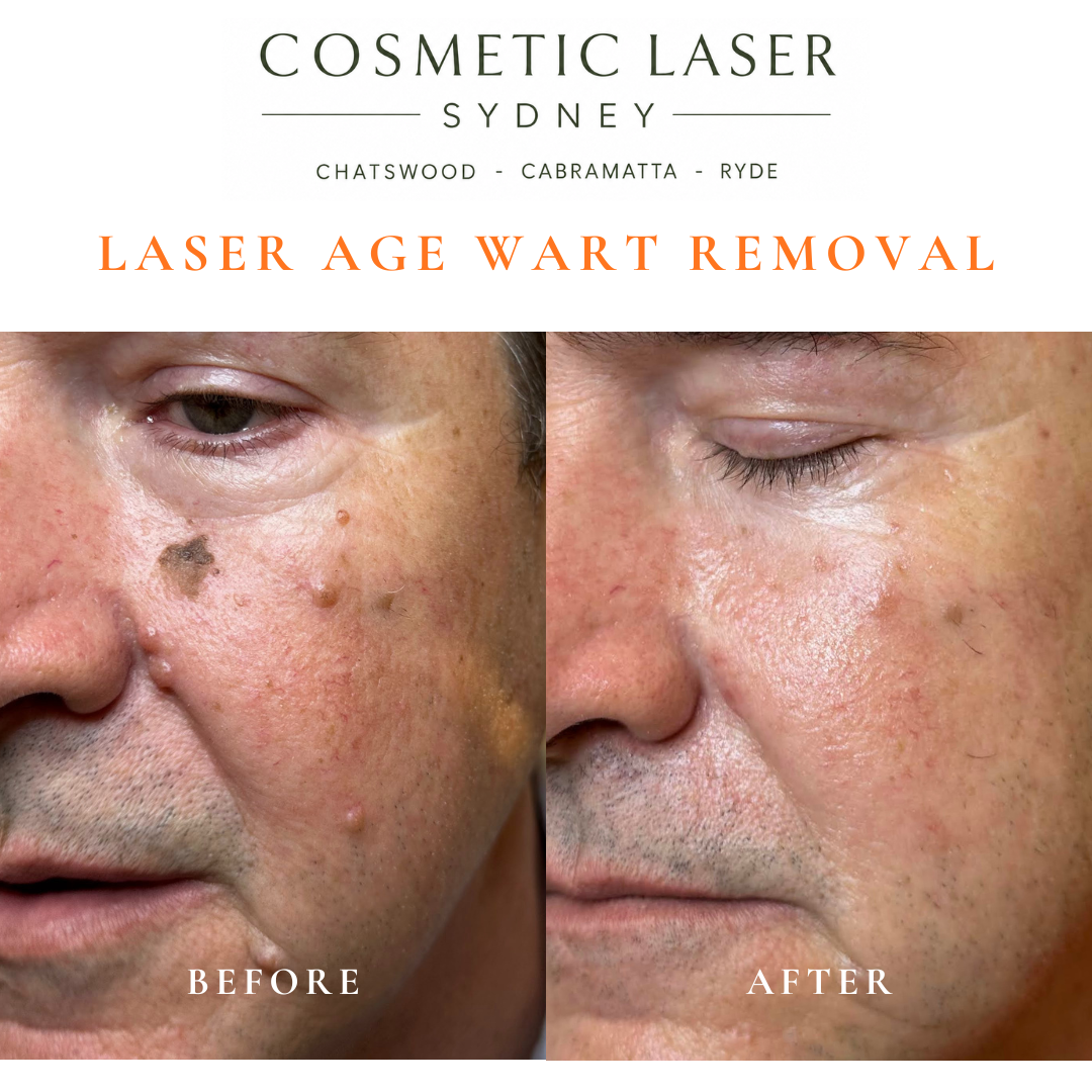 Cosmetic laser clinic in Sydney specialising in seborrhoeic keratosis and age wart laser removal for all skin types. See thousands of before and after photos.