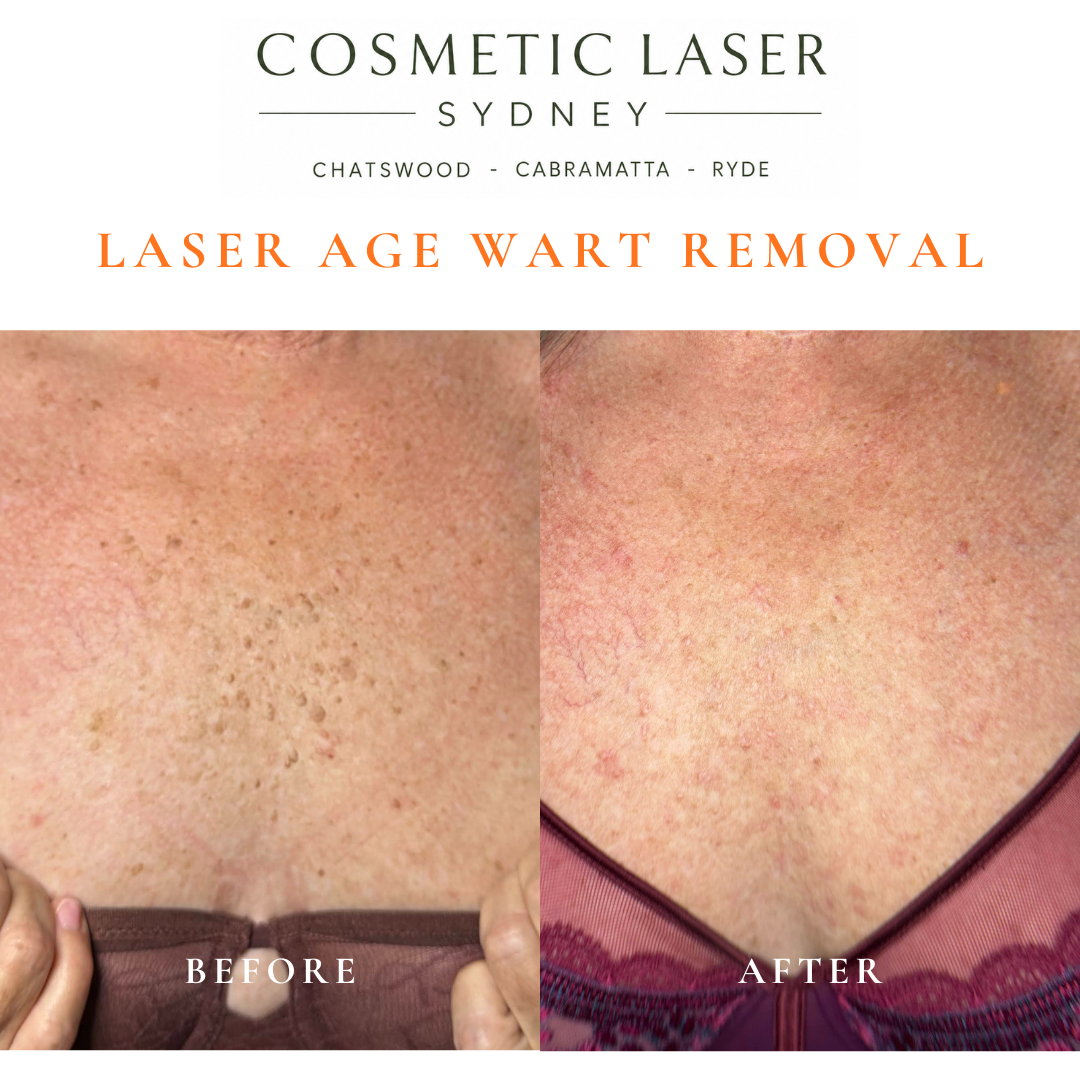 Cosmetic laser clinic in Sydney specialising in seborrhoeic keratosis and age wart laser removal for all skin types. See thousands of before and after photos.