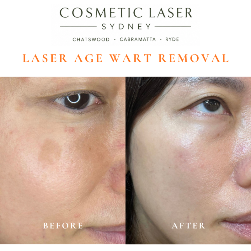 Cosmetic laser clinic in Sydney specialising in seborrhoeic keratosis and age wart laser removal for all skin types. See thousands of before and after photos.