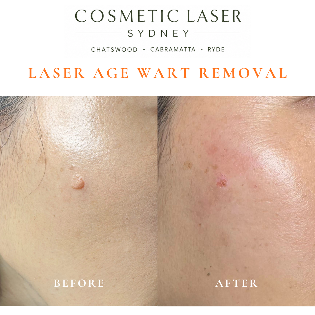Cosmetic laser clinic in Sydney specialising in seborrhoeic keratosis and age wart laser removal for all skin types. See thousands of before and after photos.