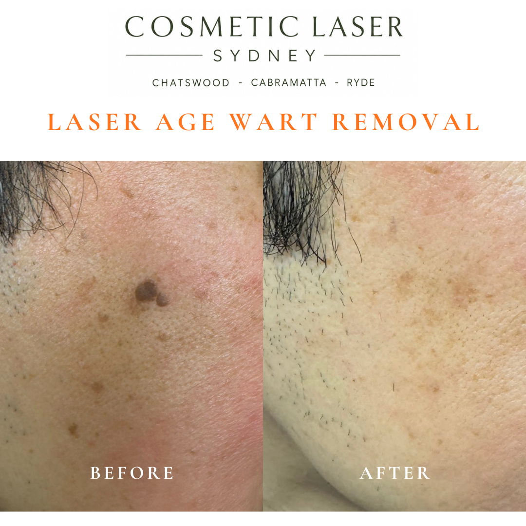 Cosmetic laser clinic in Sydney specialising in seborrhoeic keratosis and age wart laser removal for all skin types. See thousands of before and after photos.