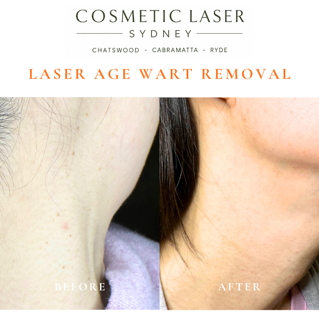 Cosmetic laser clinic in Sydney specialising in seborrhoeic keratosis and age wart laser removal for all skin types. See thousands of before and after photos.
