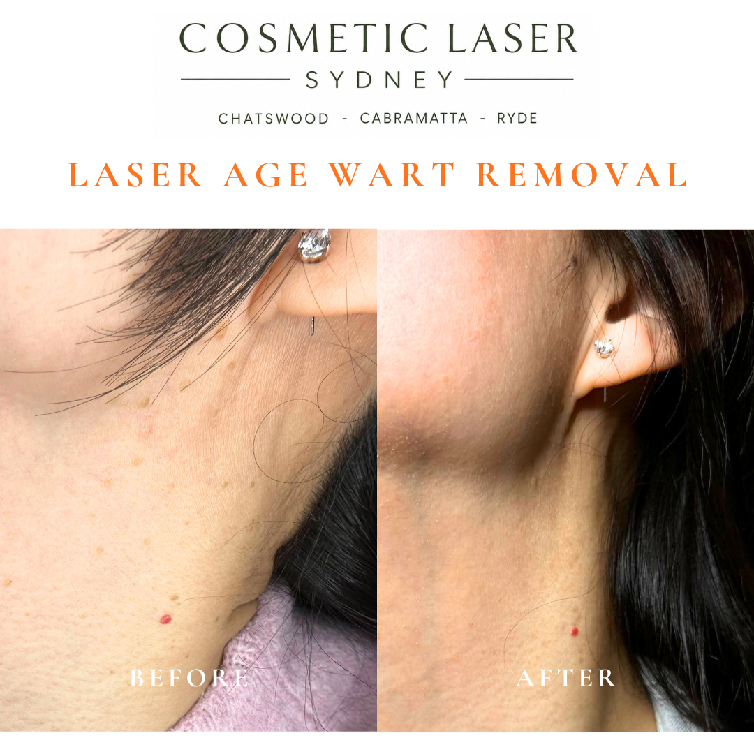 Cosmetic laser clinic in Sydney specialising in seborrhoeic keratosis and age wart laser removal for all skin types. See thousands of before and after photos.
