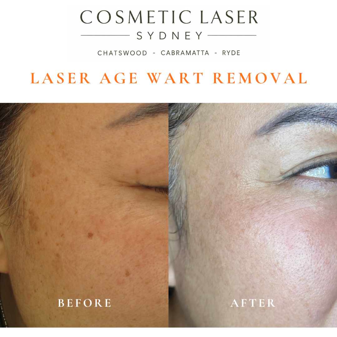 π Multiple age spots on an Asian middle-aged woman. Laser age spot removal successfully removed the pigmented lesions.