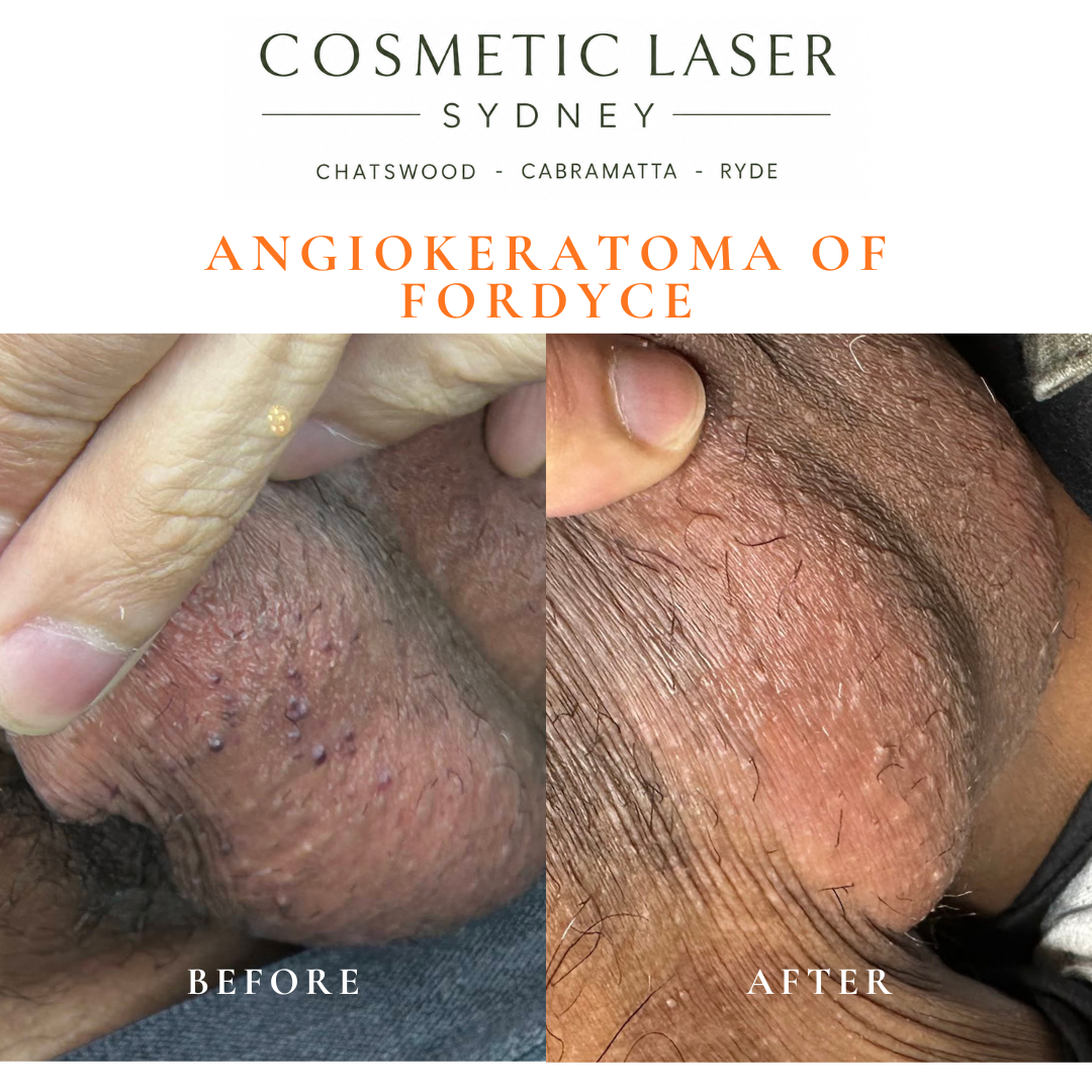 Angokeratoma of fordyce of the scrotum skin removal before and after vascular laser treatment by Dr Peter Kim Cosmetic Laser Sydney Chatswood Cabramatta Ryde