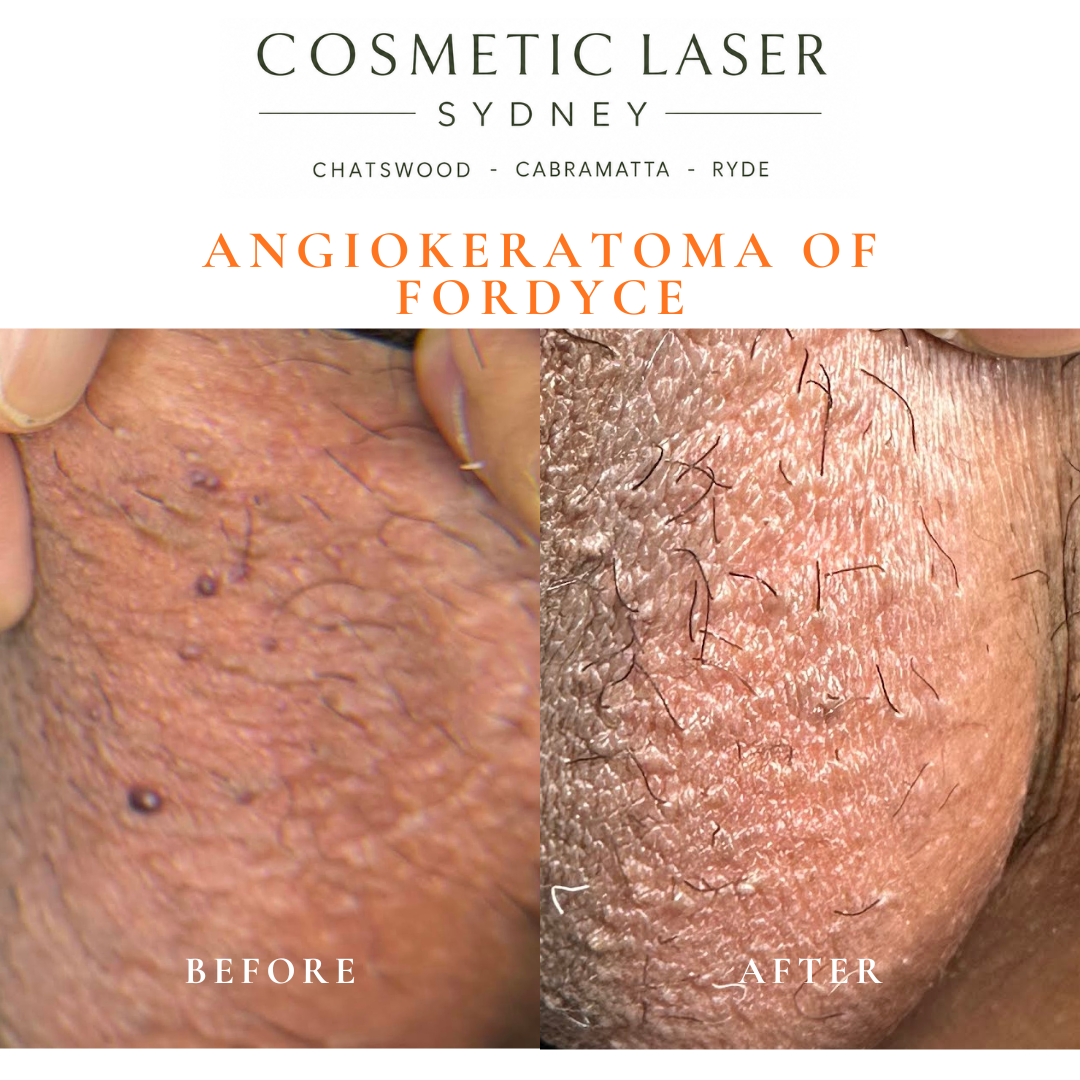 Angokeratoma of fordyce of the scrotum skin removal before and after vascular laser treatment by Dr Peter Kim Cosmetic Laser Sydney Chatswood Cabramatta Ryde