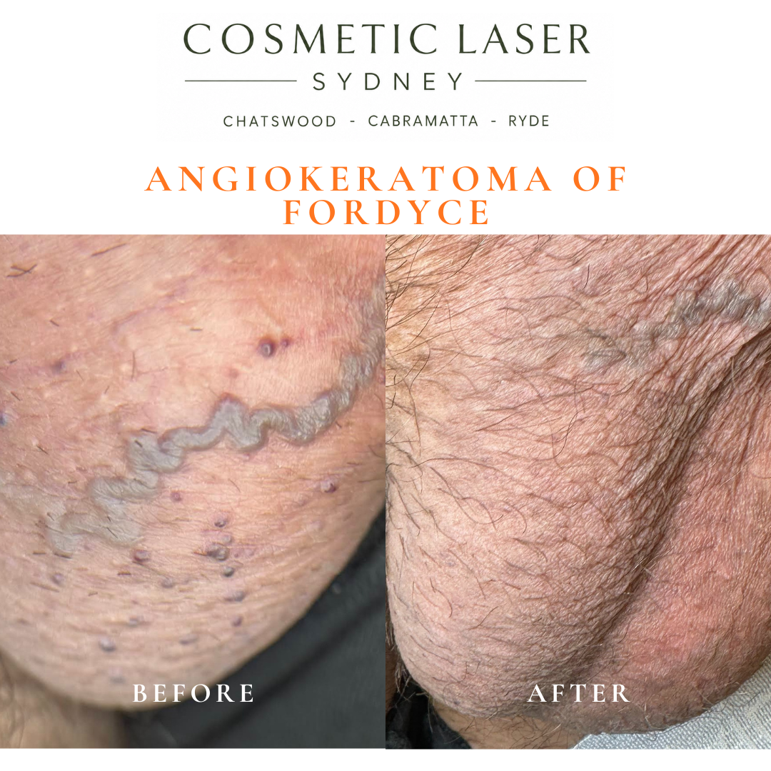 Angokeratoma of fordyce of the scrotum skin removal before and after vascular laser treatment by Dr Peter Kim Cosmetic Laser Sydney Chatswood Cabramatta Ryde