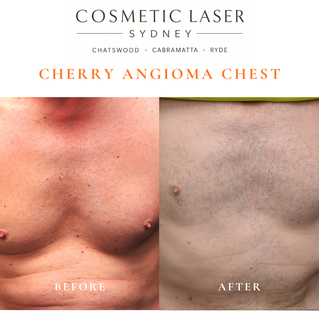 multiple cherry angioma or campbell de morgan spot of the chest removal before and after vascular laser treatment by Dr Peter Kim Cosmetic Laser Sydney Chatswood Cabramatta Ryde