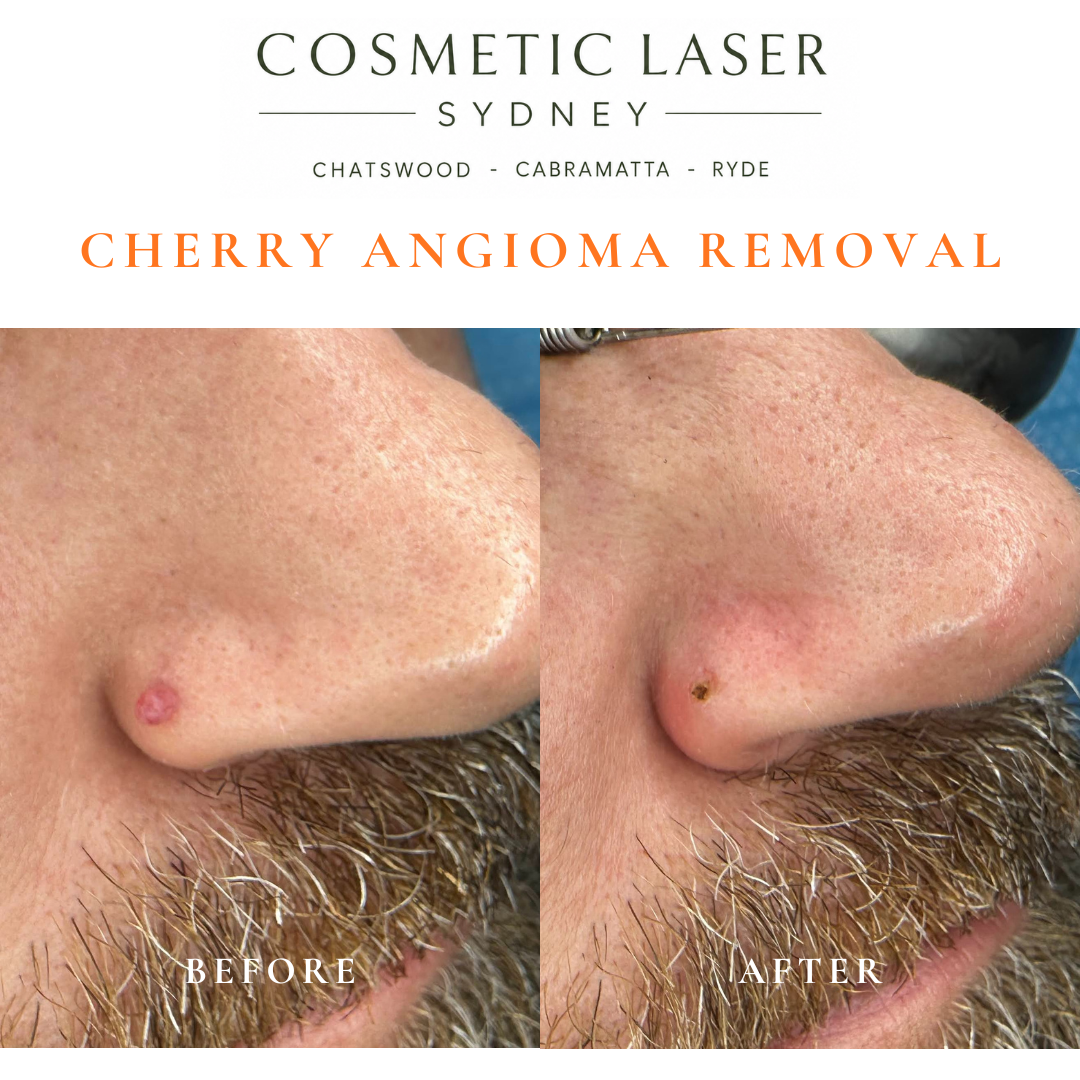 Cherry angioma or campbell de morgan spot of the temple removal before and after vascular laser treatment by Dr Peter Kim Cosmetic Laser Sydney Chatswood Cabramatta Ryde