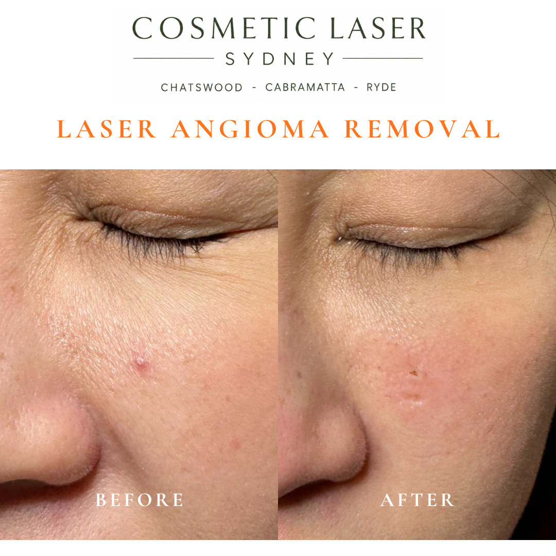 Cherry angioma or campbell de morgan spot of the Face and cheek removal before and after vascular laser treatment by Dr Peter Kim Cosmetic Laser Sydney Chatswood Cabramatta Ryde