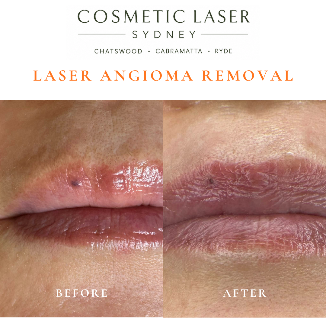 Cherry angioma or campbell de morgan spot of the lip removal before and after vascular laser treatment by Dr Peter Kim Cosmetic Laser Sydney Chatswood Cabramatta Ryde