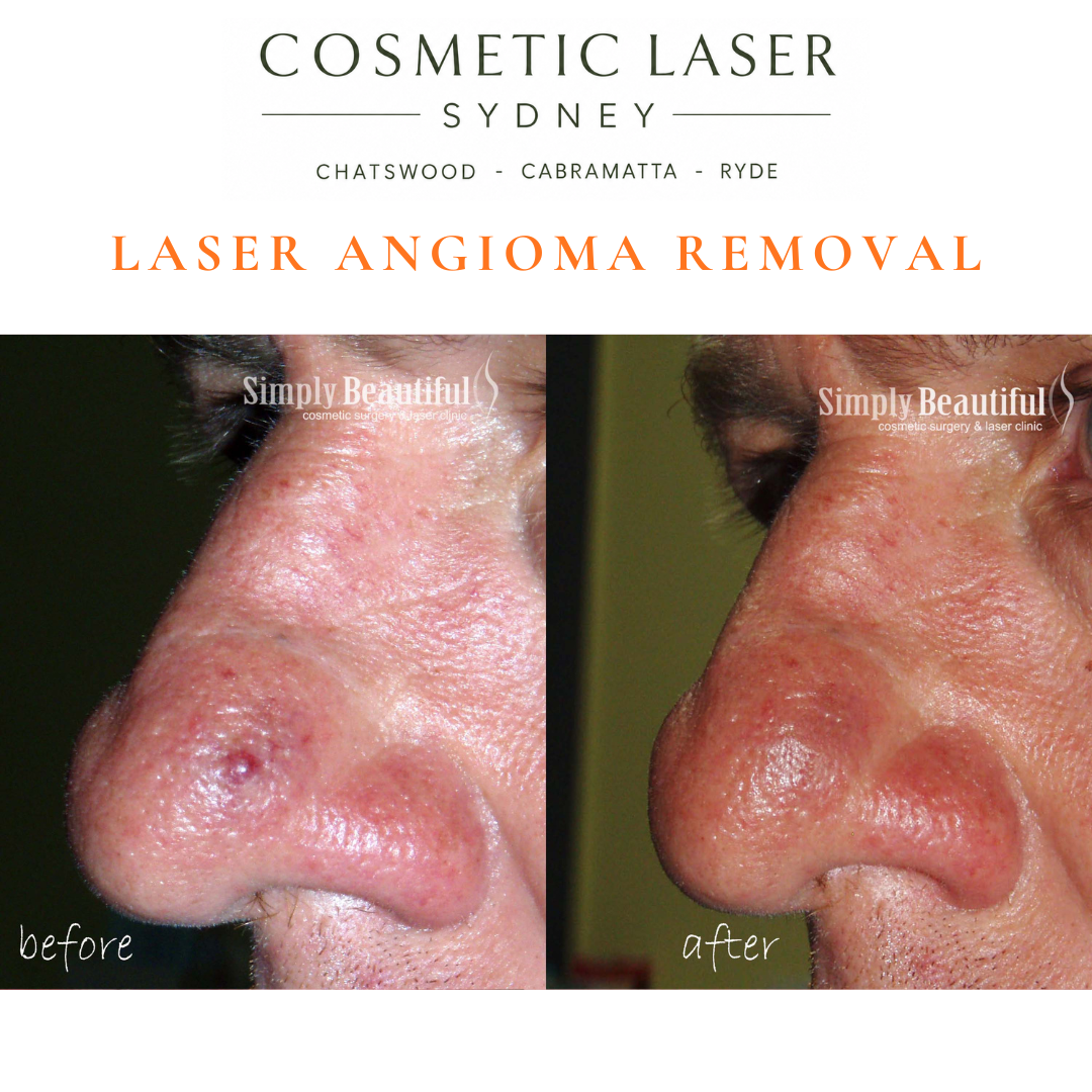 Cherry angioma of the nose treated with our vascular laser in sydney chatswood cabramatta