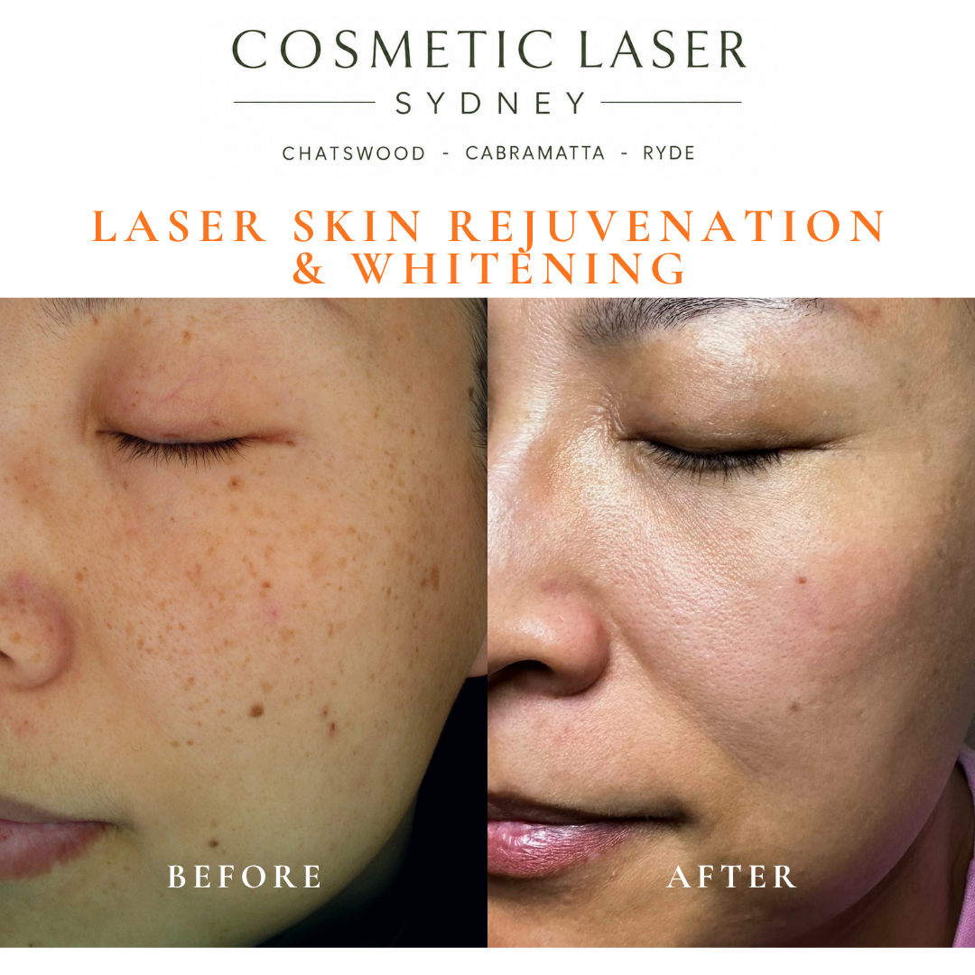 Before and after laser melasma freckle pigmentation treatment and skin whitening by Dr Peter Kim - 20 years experience Sydney (Chatswood, Cabramatta, Ryde)