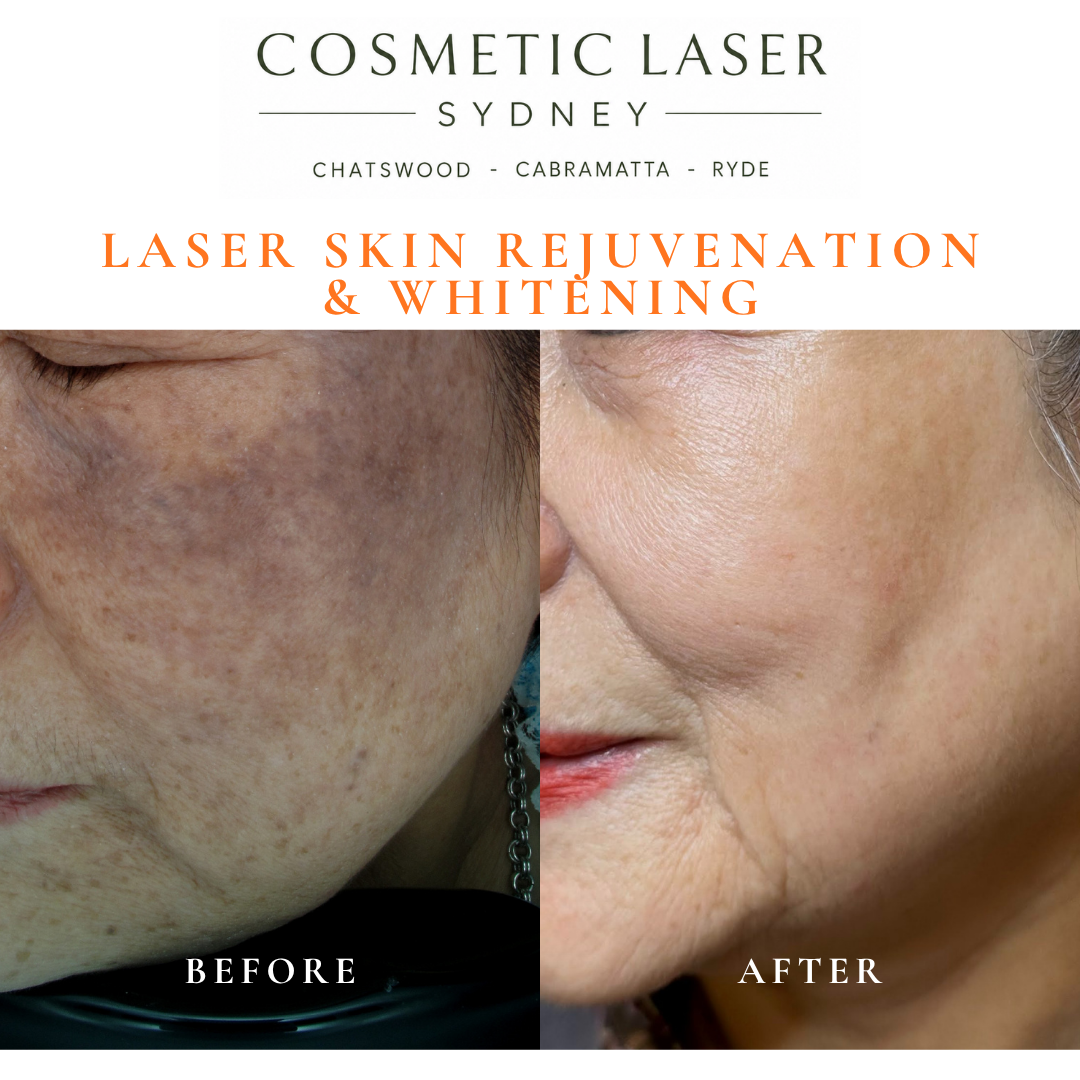 Before and after laser melasma freckle pigmentation treatment and skin whitening by Dr Peter Kim - 20 years experience Sydney (Chatswood, Cabramatta, Ryde)