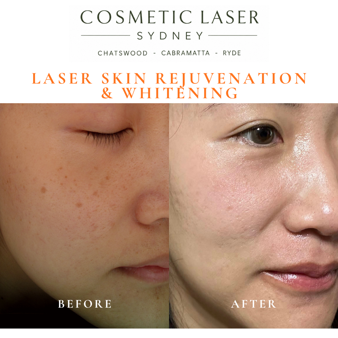 Before and after laser melasma freckle pigmentation treatment and skin whitening by Dr Peter Kim - 20 years experience Sydney (Chatswood, Cabramatta, Ryde)