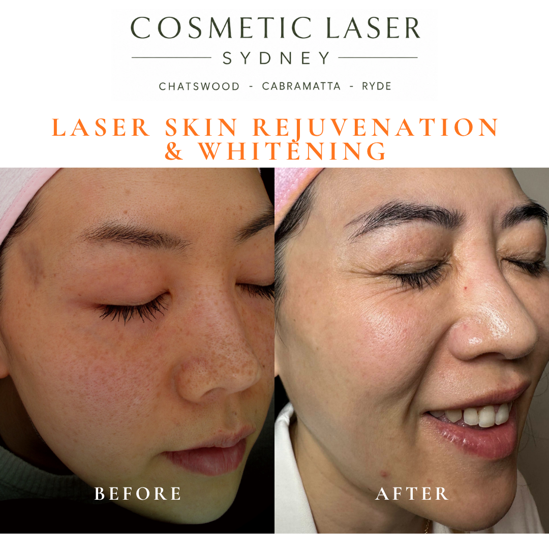 Before and after laser melasma freckle pigmentation treatment and skin whitening by Dr Peter Kim - 20 years experience Sydney (Chatswood, Cabramatta, Ryde)