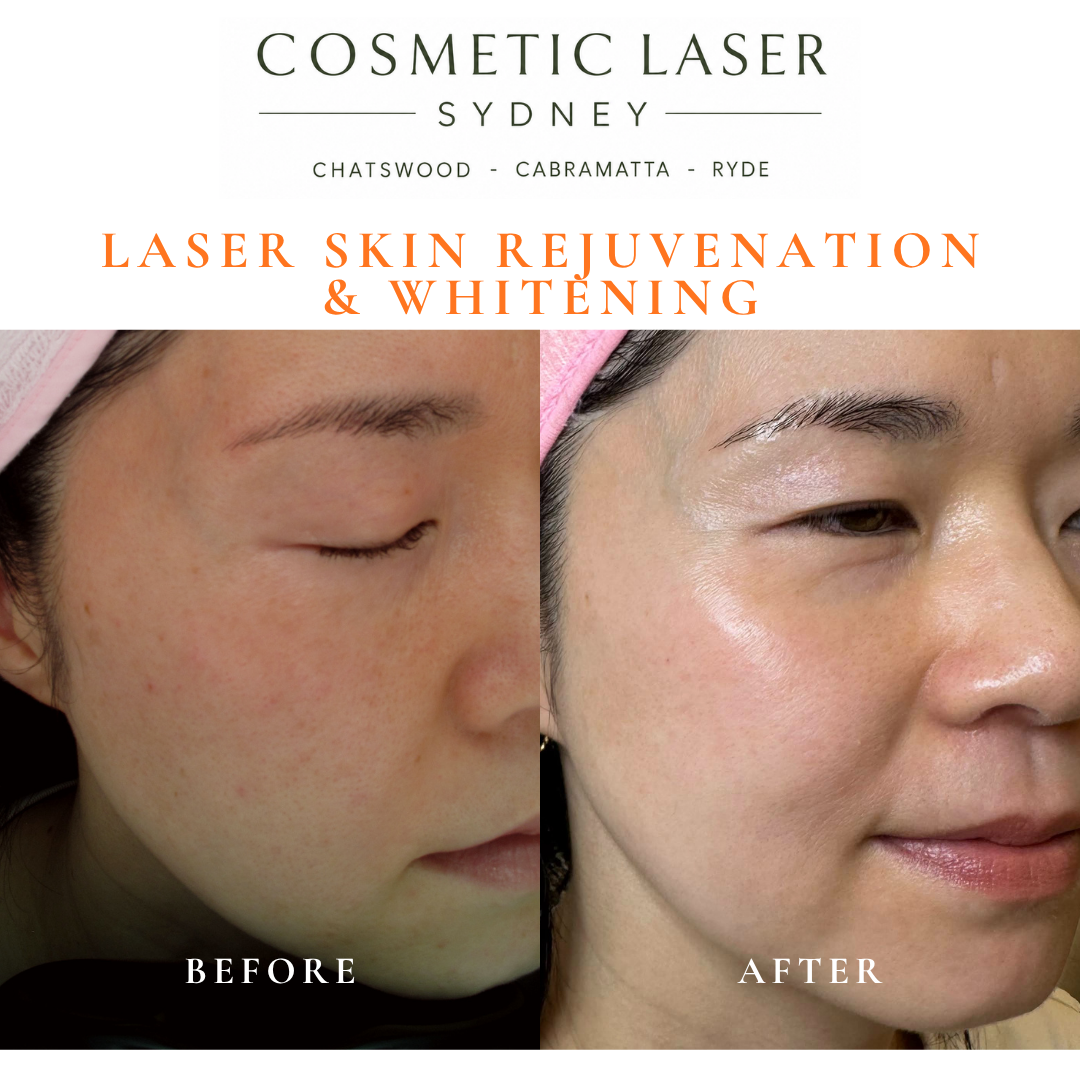 Before and after laser melasma freckle pigmentation treatment and skin whitening by Dr Peter Kim - 20 years experience Sydney (Chatswood, Cabramatta, Ryde)