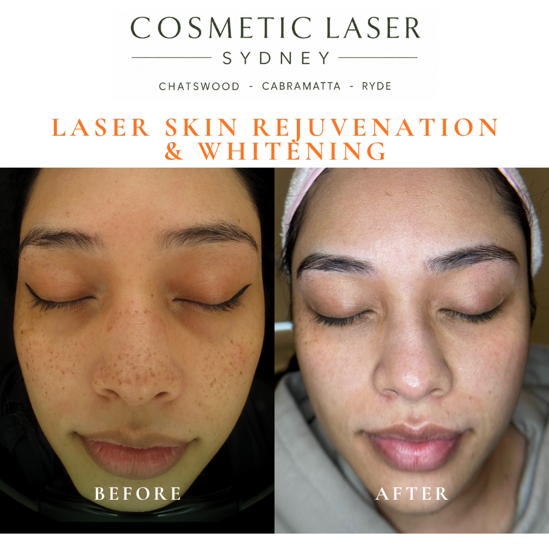 Before and after laser melasma freckle pigmentation treatment and skin whitening by Dr Peter Kim - 20 years experience Sydney (Chatswood, Cabramatta, Ryde)