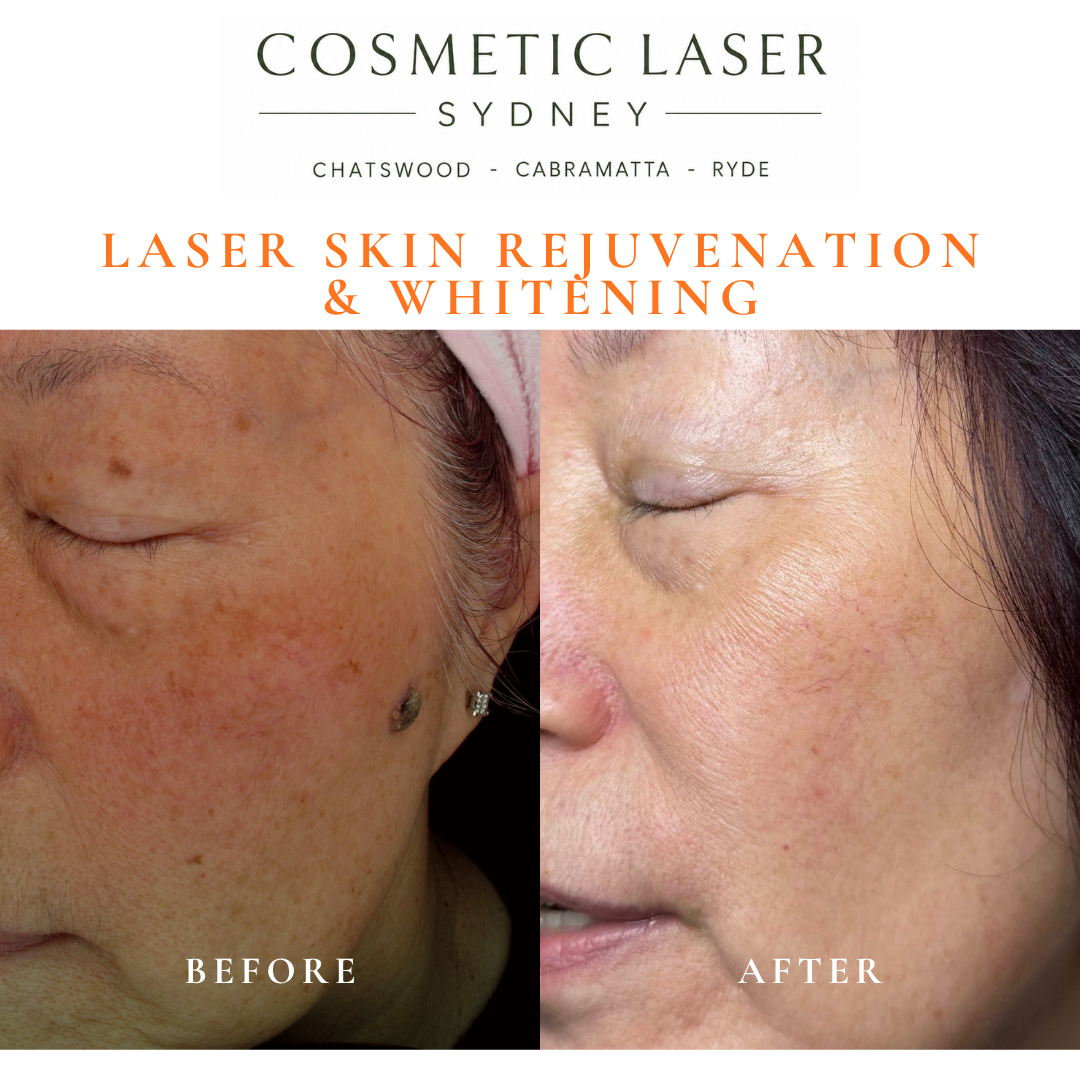 Before and after laser melasma freckle pigmentation treatment and skin whitening by Dr Peter Kim - 20 years experience Sydney (Chatswood, Cabramatta, Ryde)