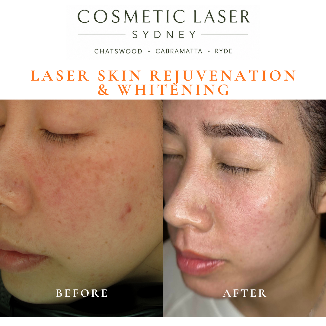 Before and after laser melasma freckle pigmentation treatment and skin whitening by Dr Peter Kim - 20 years experience Sydney (Chatswood, Cabramatta, Ryde)