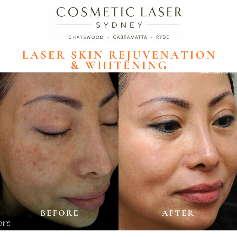 Before and after laser melasma freckle pigmentation treatment and skin whitening by Dr Peter Kim - 20 years experience Sydney (Chatswood, Cabramatta, Ryde)