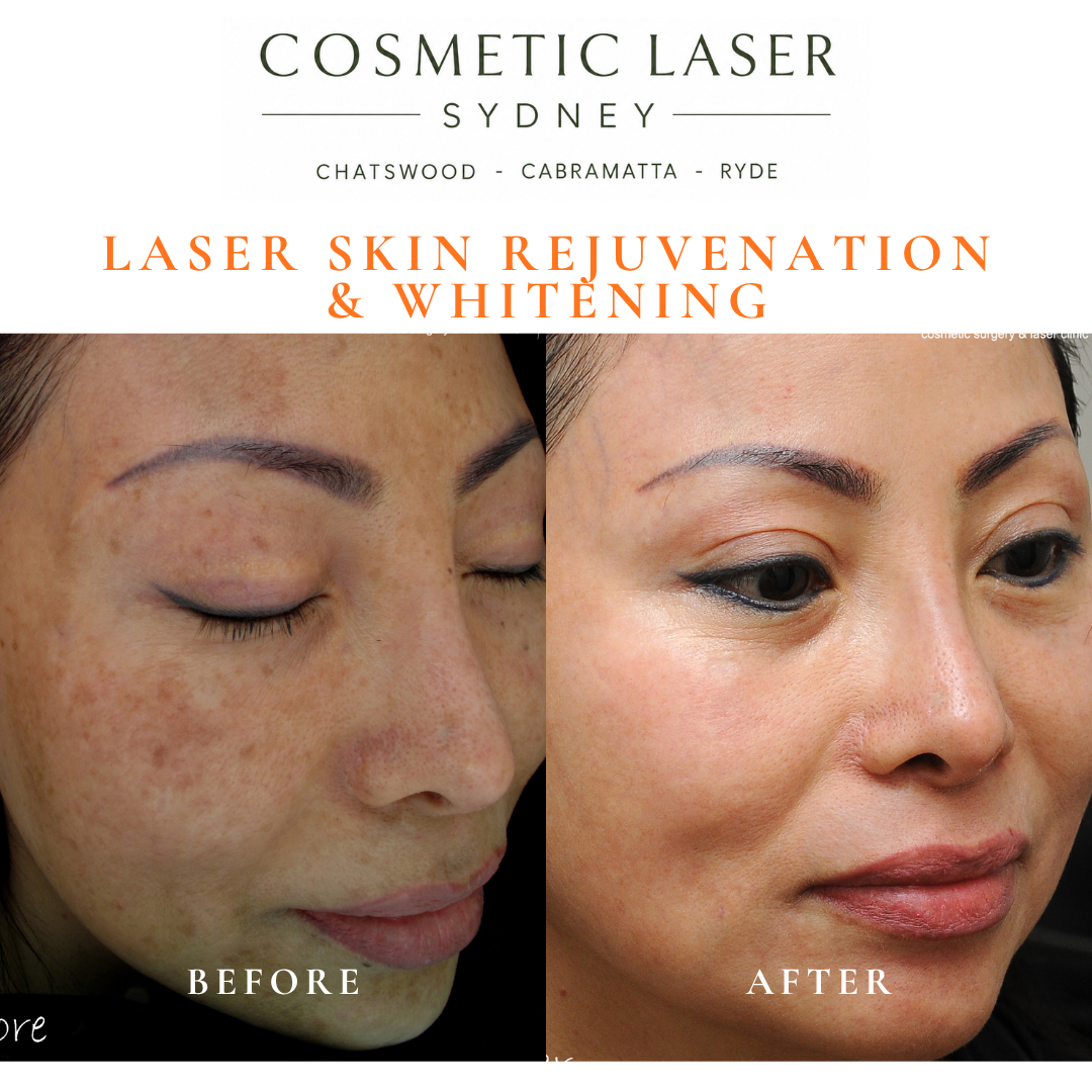 Before and after laser melasma freckle pigmentation treatment and skin whitening by Dr Peter Kim - 20 years experience Sydney (Chatswood, Cabramatta, Ryde)