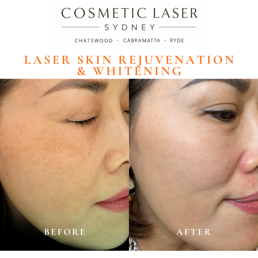 Before and after laser melasma freckle pigmentation treatment and skin whitening by Dr Peter Kim - 20 years experience Sydney (Chatswood, Cabramatta, Ryde)