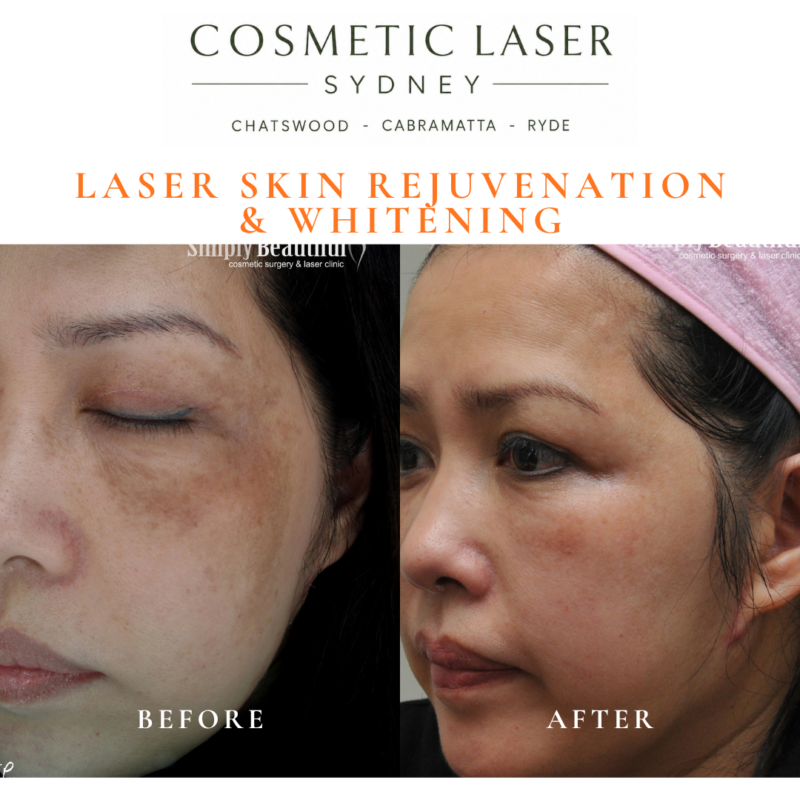 Before and after laser melasma freckle pigmentation treatment and skin whitening by Dr Peter Kim - 20 years experience Sydney (Chatswood, Cabramatta, Ryde)