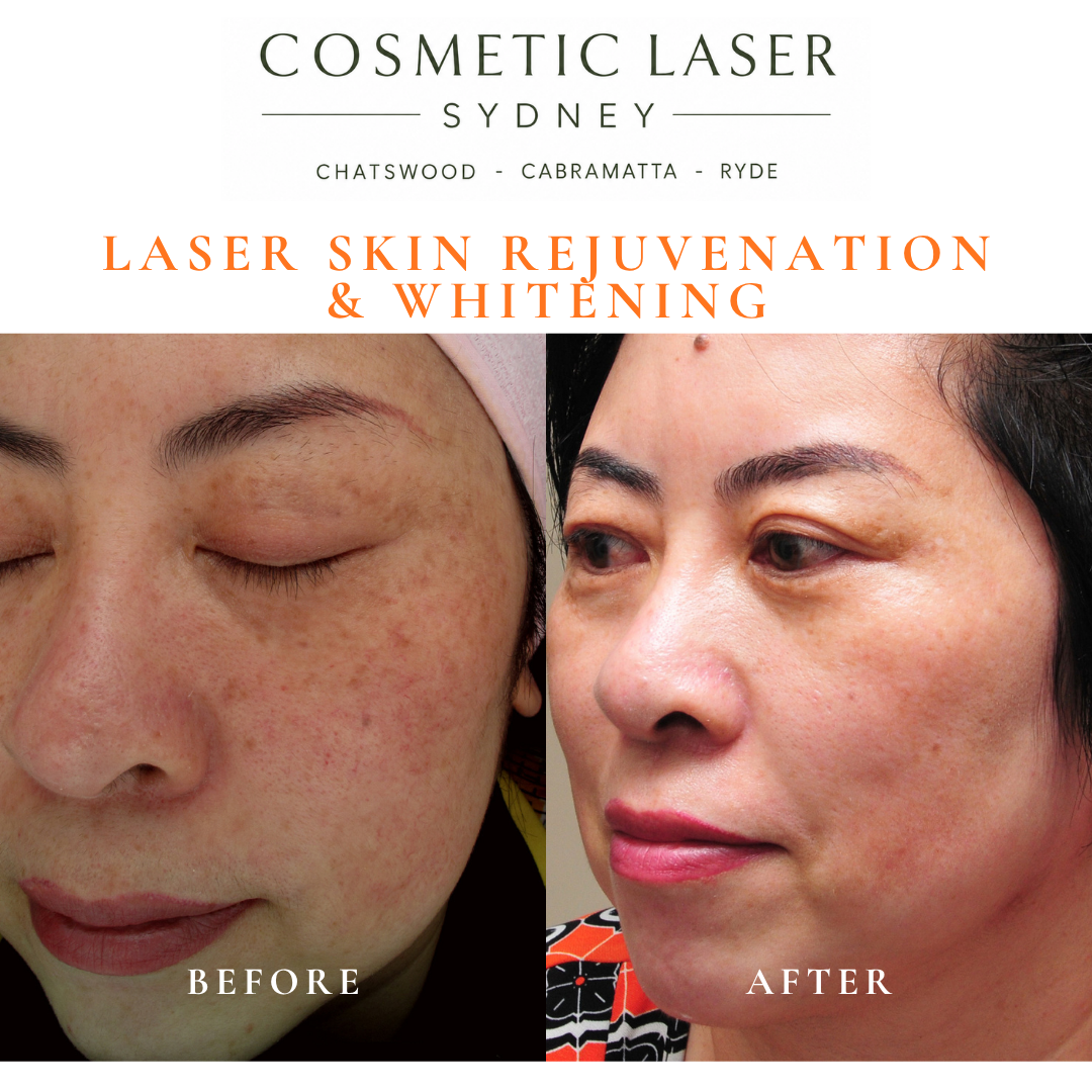 Before and after laser melasma freckle pigmentation treatment and skin whitening by Dr Peter Kim - 20 years experience Sydney (Chatswood, Cabramatta, Ryde)