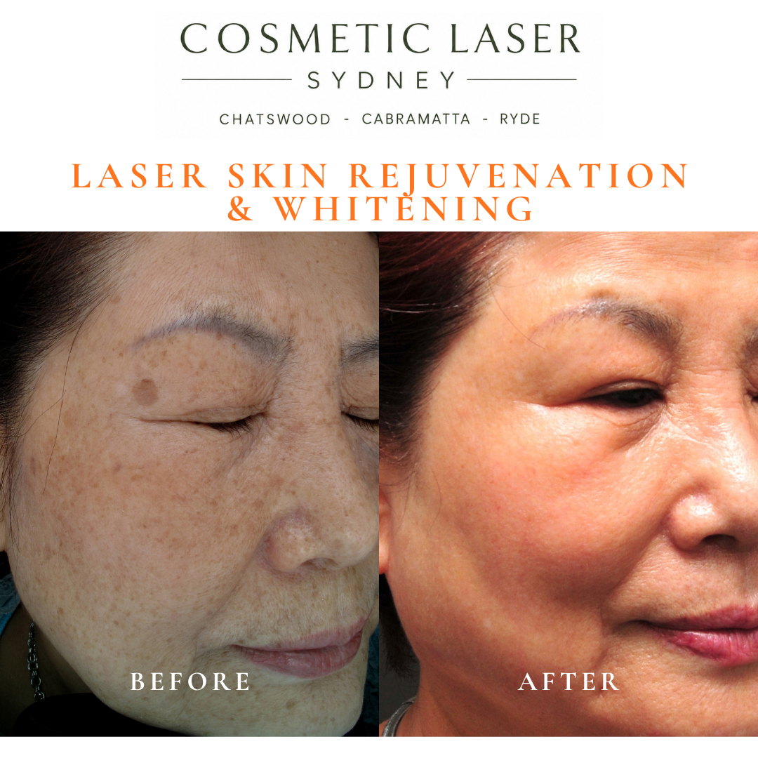 Before and after laser melasma freckle pigmentation treatment and skin whitening by Dr Peter Kim - 20 years experience Sydney (Chatswood, Cabramatta, Ryde)