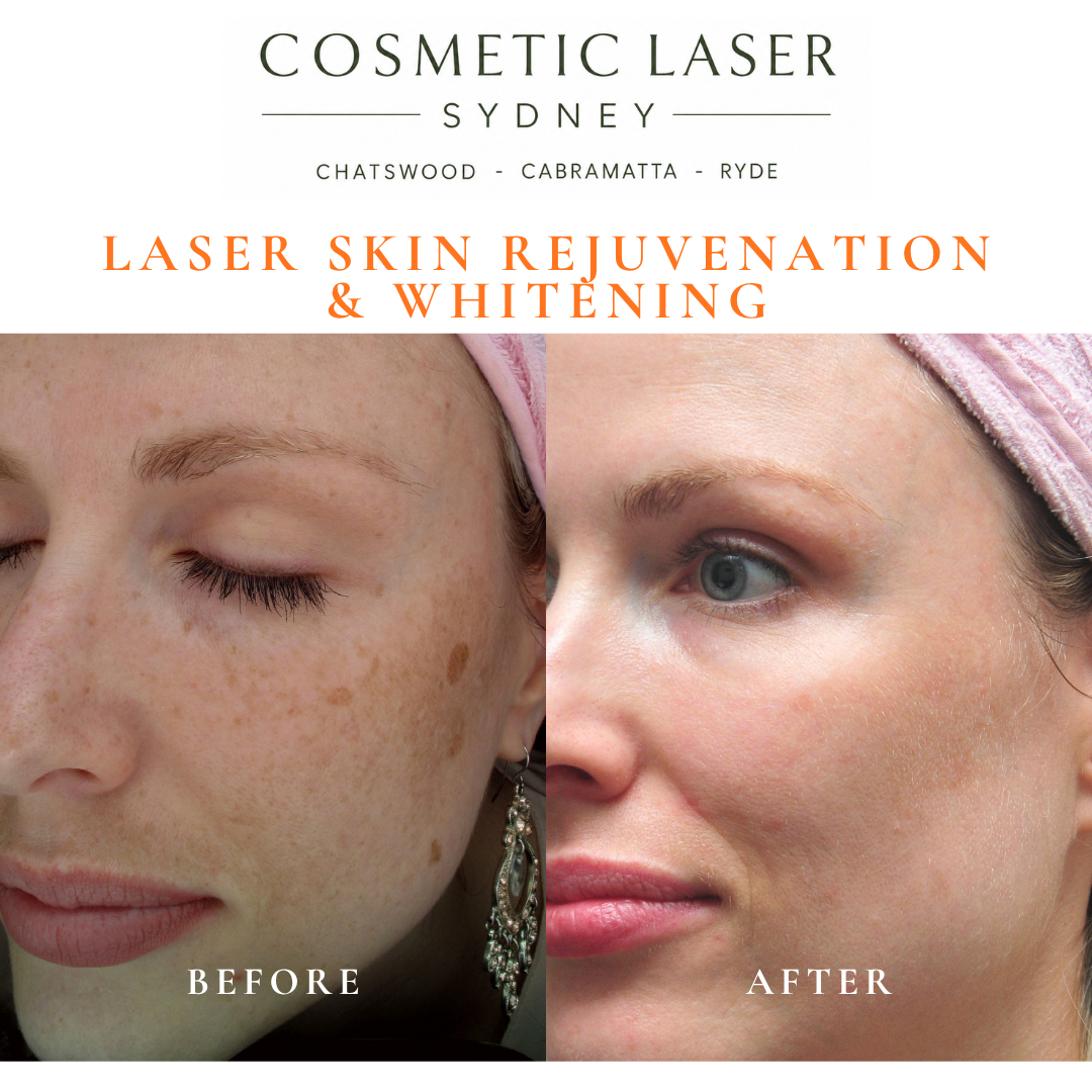 Before and after laser melasma freckle pigmentation treatment and skin whitening by Dr Peter Kim - 20 years experience Sydney (Chatswood, Cabramatta, Ryde)
