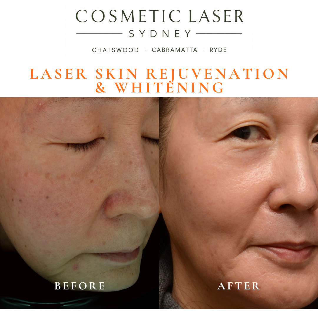 Before and after laser melasma freckle pigmentation treatment and skin whitening by Dr Peter Kim - 20 years experience Sydney (Chatswood, Cabramatta, Ryde)