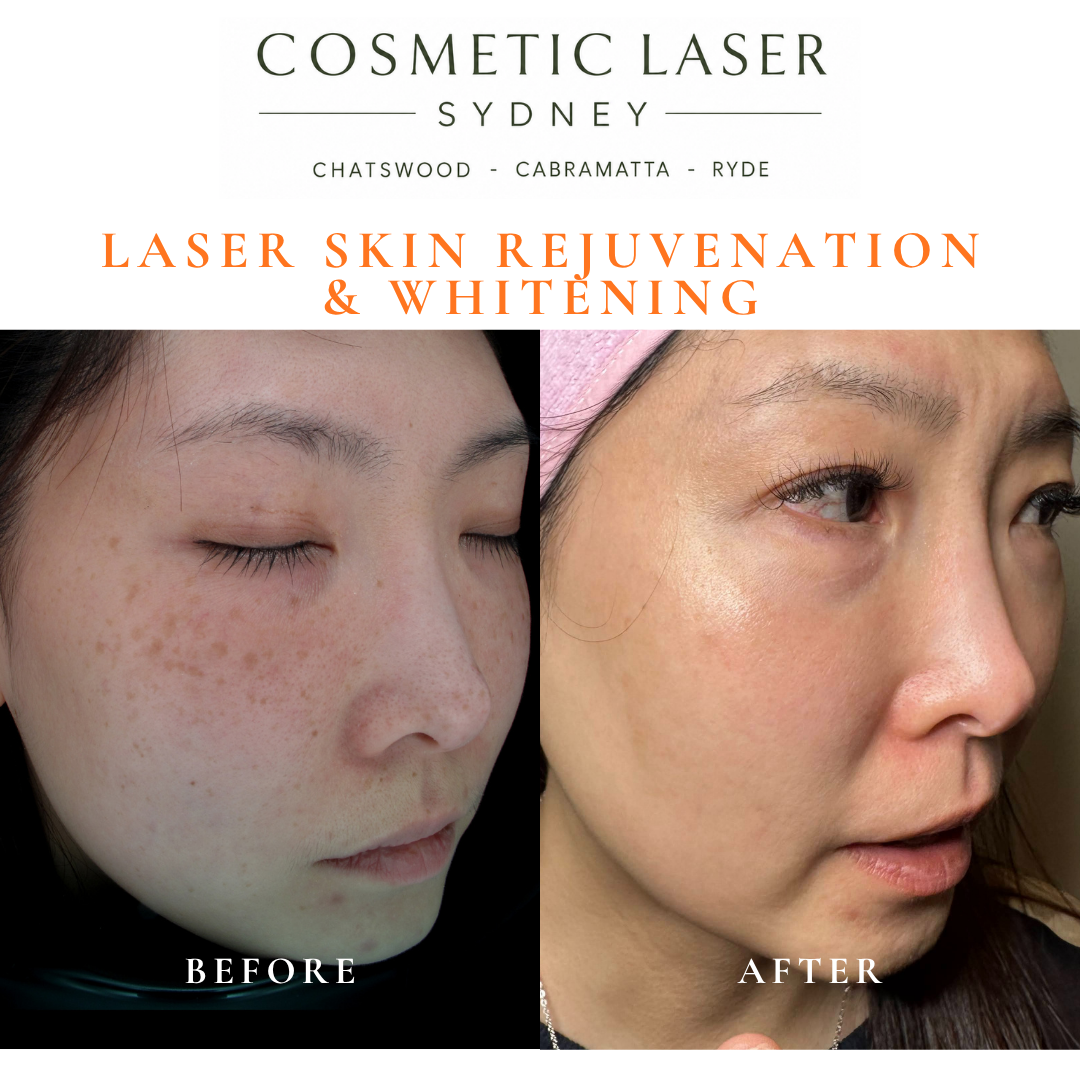 Before and after laser melasma freckle pigmentation treatment and skin whitening by Dr Peter Kim - 20 years experience Sydney (Chatswood, Cabramatta, Ryde)