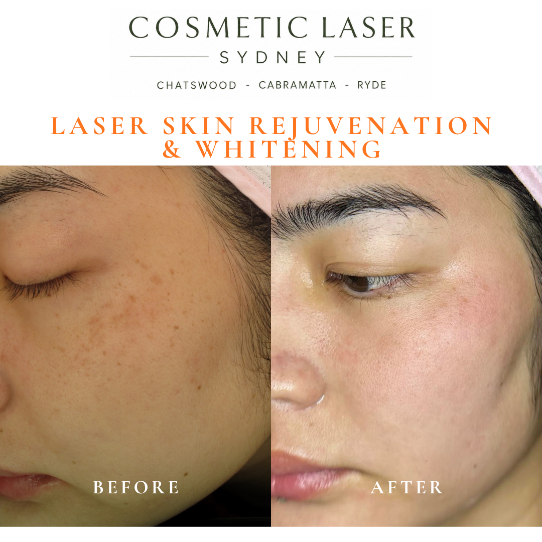Before and after laser melasma freckle pigmentation treatment and skin whitening by Dr Peter Kim - 20 years experience Sydney (Chatswood, Cabramatta, Ryde)