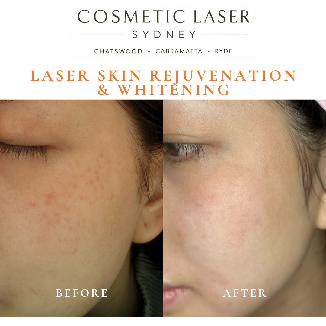 Before and after laser melasma freckle pigmentation treatment and skin whitening by Dr Peter Kim - 20 years experience Sydney (Chatswood, Cabramatta, Ryde)