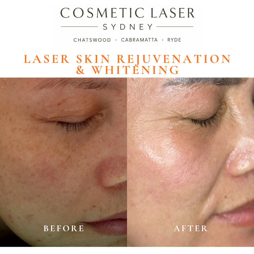 Before and after laser melasma freckle pigmentation treatment and skin whitening by Dr Peter Kim - 20 years experience Sydney (Chatswood, Cabramatta, Ryde)