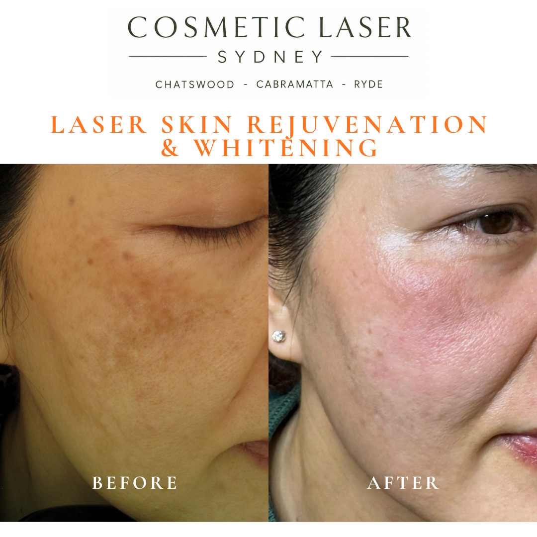 Before and after laser melasma freckle pigmentation treatment and skin whitening by Dr Peter Kim - 20 years experience Sydney (Chatswood, Cabramatta, Ryde)