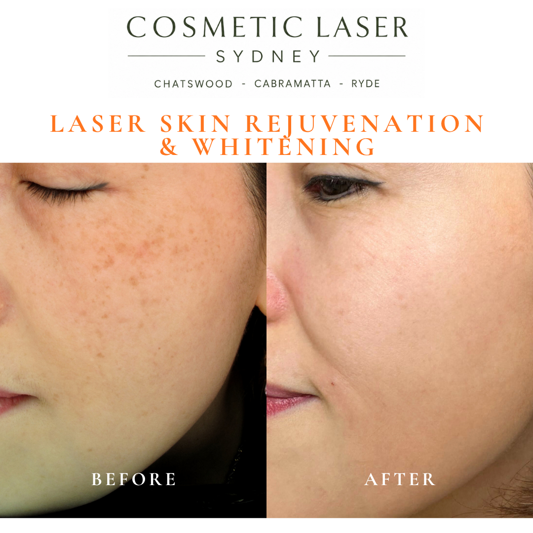 Before and after laser melasma freckle pigmentation treatment and skin whitening by Dr Peter Kim - 20 years experience Sydney (Chatswood, Cabramatta, Ryde)