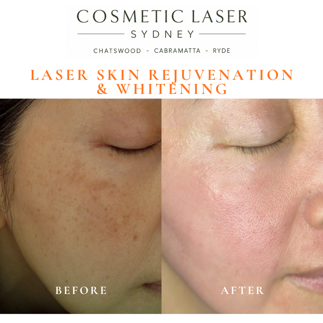 Before and after laser melasma freckle pigmentation treatment and skin whitening by Dr Peter Kim - 20 years experience Sydney (Chatswood, Cabramatta, Ryde)