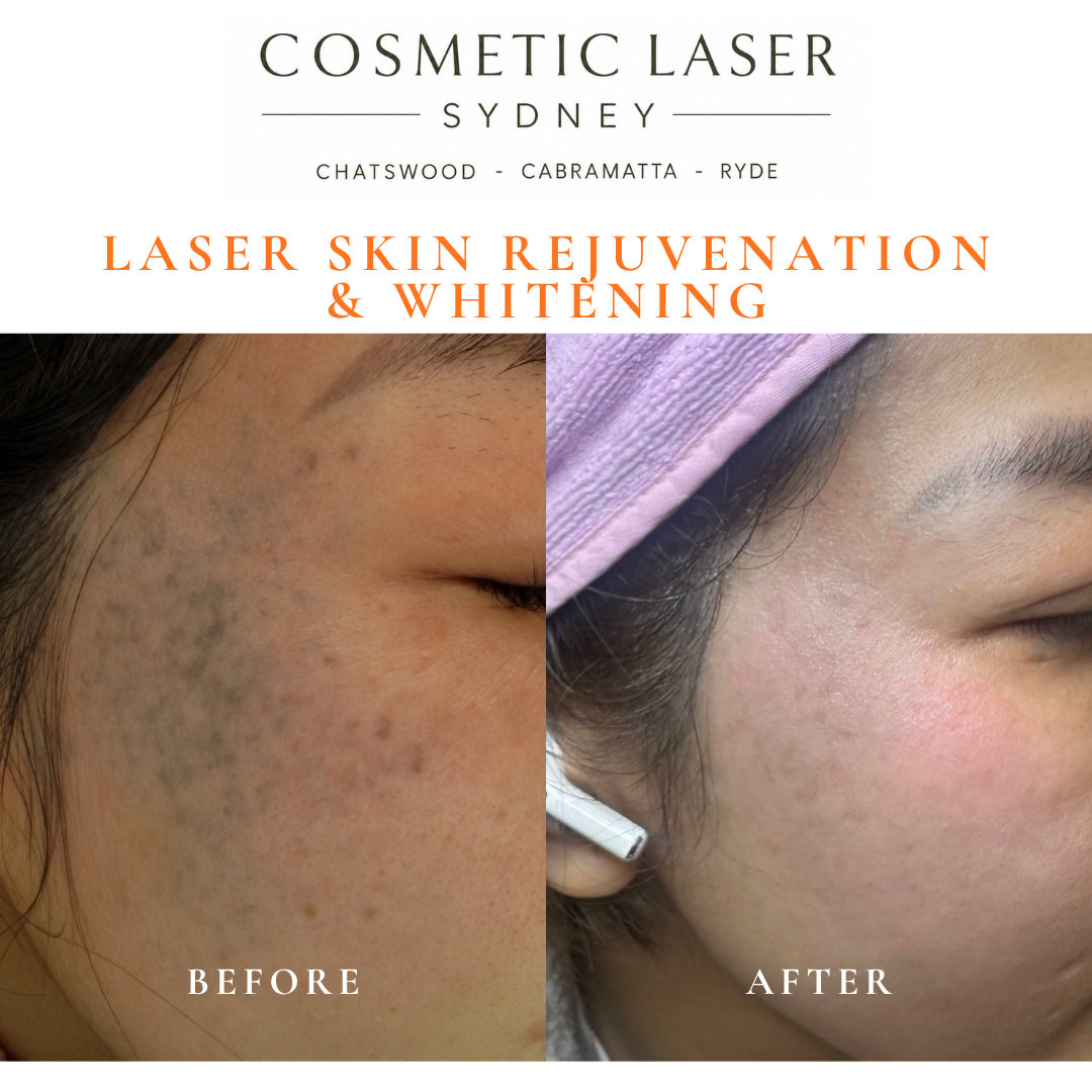 Before and after laser melasma freckle pigmentation treatment and skin whitening by Dr Peter Kim - 20 years experience Sydney (Chatswood, Cabramatta, Ryde)