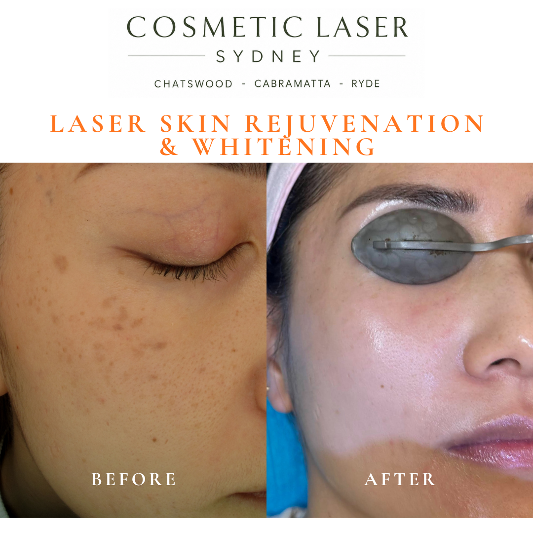Before and after laser melasma freckle pigmentation treatment and skin whitening by Dr Peter Kim - 20 years experience Sydney (Chatswood, Cabramatta, Ryde)