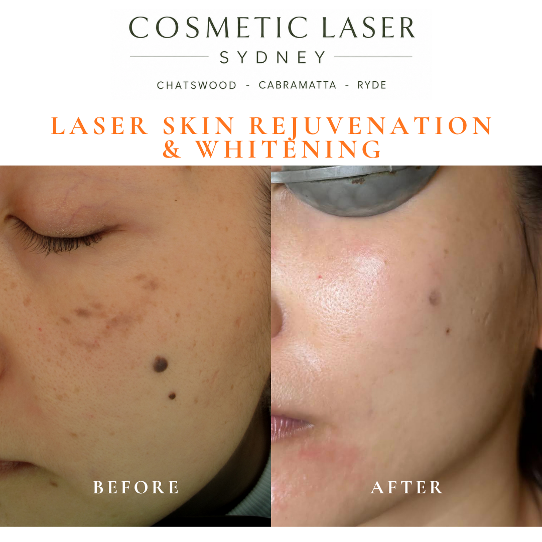 Before and after laser melasma freckle pigmentation treatment and skin whitening by Dr Peter Kim - 20 years experience Sydney (Chatswood, Cabramatta, Ryde)