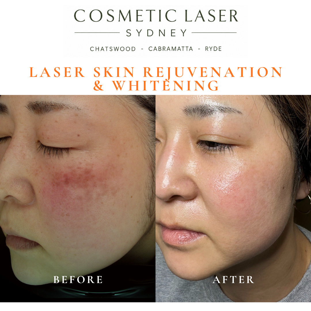 Before and after laser melasma freckle pigmentation treatment and skin whitening by Dr Peter Kim - 20 years experience Sydney (Chatswood, Cabramatta, Ryde)