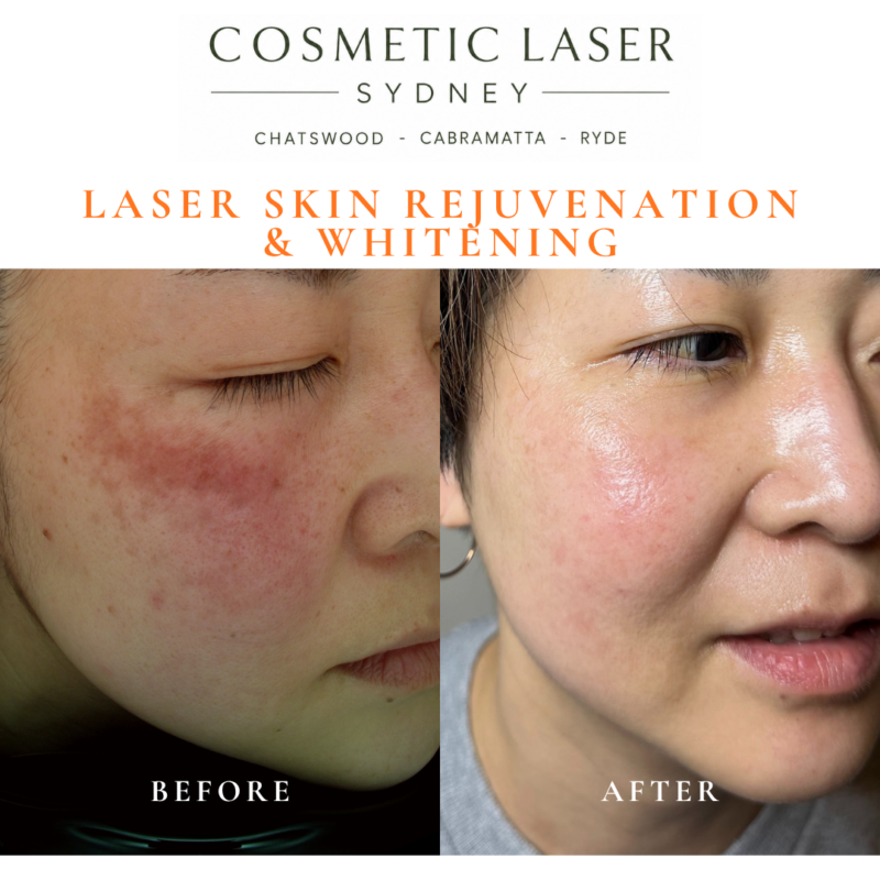 Before and after laser melasma freckle pigmentation treatment and skin whitening by Dr Peter Kim - 20 years experience Sydney (Chatswood, Cabramatta, Ryde)