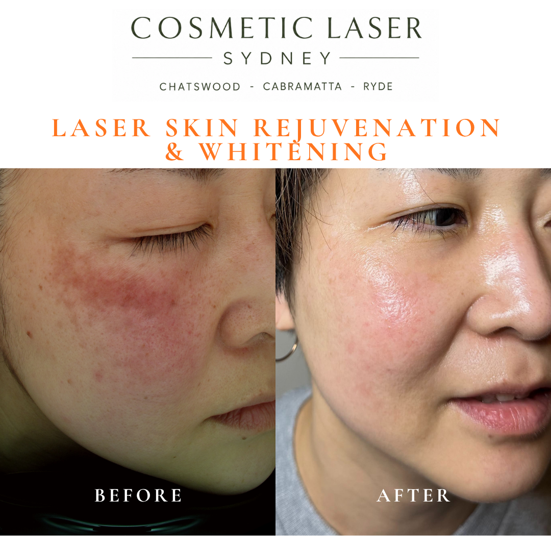Before and after laser melasma freckle pigmentation treatment and skin whitening by Dr Peter Kim - 20 years experience Sydney (Chatswood, Cabramatta, Ryde)