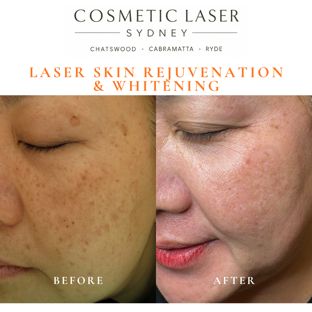 Before and after laser melasma freckle pigmentation treatment and skin whitening by Dr Peter Kim - 20 years experience Sydney (Chatswood, Cabramatta, Ryde)