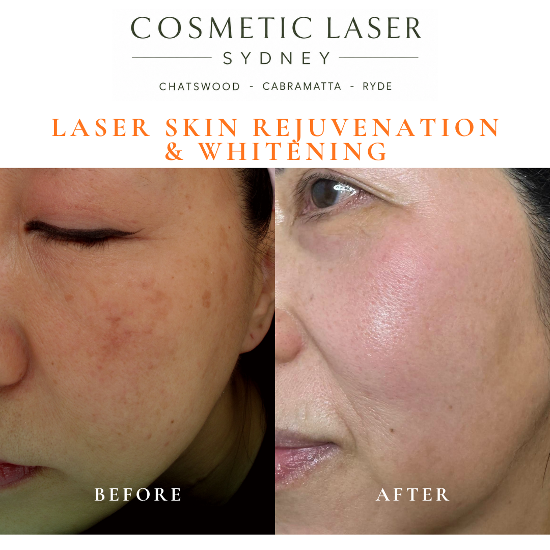 Before and after laser melasma freckle pigmentation treatment and skin whitening by Dr Peter Kim - 20 years experience Sydney (Chatswood, Cabramatta, Ryde)